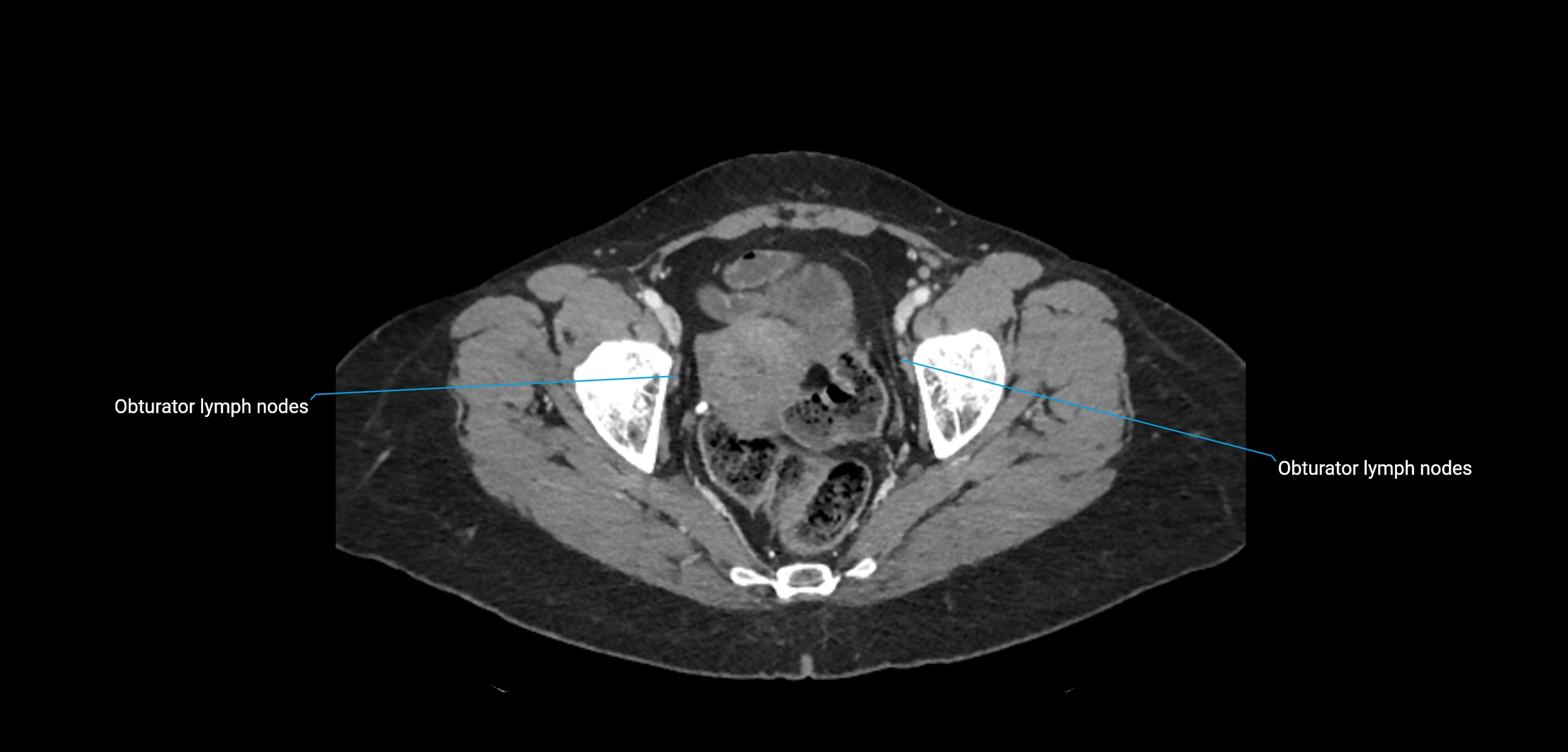 CT ct abdominal lymph nodes  axial cross sectional anatomy  enchanced radiology image -img-00002-00372.webp
